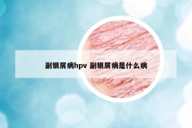 副银屑病hpv 副银屑病是什么病