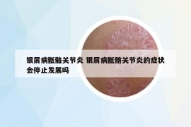 银屑病骶骼关节炎 银屑病骶髂关节炎的症状会停止发展吗