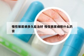 慢性银屑病多久能治好 慢性银屑病擦什么药膏