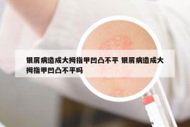 银屑病造成大拇指甲凹凸不平 银屑病造成大拇指甲凹凸不平吗