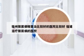 福州银屑病哪里治比较好的医院比较好 福建治疗银屑病的医院