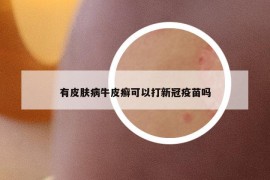 有皮肤病牛皮癣可以打新冠疫苗吗