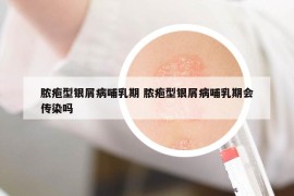 脓疱型银屑病哺乳期 脓疱型银屑病哺乳期会传染吗