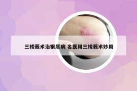 三棱莪术治银屑病 名医用三棱莪术妙用