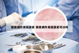 银屑病外用弱激素 银屑病外用弱激素可以吗