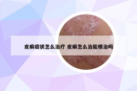 皮癣症状怎么治疗 皮癣怎么治能根治吗