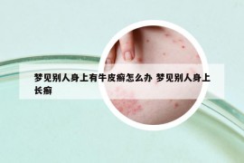 梦见别人身上有牛皮癣怎么办 梦见别人身上长癣