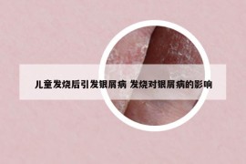 儿童发烧后引发银屑病 发烧对银屑病的影响