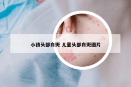 小孩头部白斑 儿童头部白斑图片