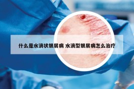 什么是水滴状银屑病 水滴型银屑病怎么治疗