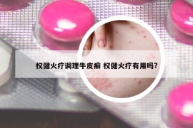 权健火疗调理牛皮癣 权健火疗有用吗?