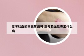 高考验血能查银屑病吗 高考验血能查出什么病