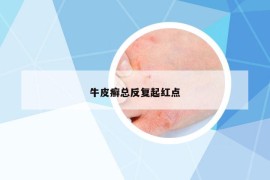 牛皮癣总反复起红点