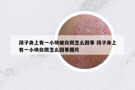 孩子身上有一小块被白斑怎么回事 孩子身上有一小块白斑怎么回事图片