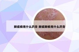 脚底癣用什么药膏 脚底脚癣用什么药膏