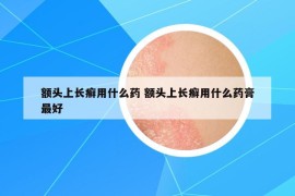 额头上长癣用什么药 额头上长癣用什么药膏最好