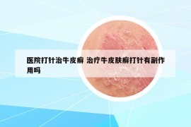 医院打针治牛皮癣 治疗牛皮肤癣打针有副作用吗