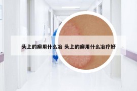 头上的癣用什么冶 头上的癣用什么冶疗好