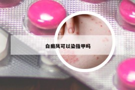 白癜风可以染指甲吗