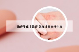 治疗牛皮廯最好 怎样才能治疗牛皮