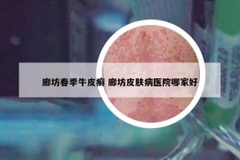 廊坊春季牛皮癣 廊坊皮肤病医院哪家好