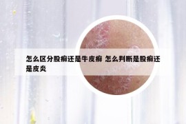 怎么区分股癣还是牛皮癣 怎么判断是股癣还是皮炎