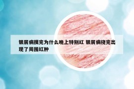 银屑病摸完为什么晚上特别红 银屑病挠完出现了周围红肿