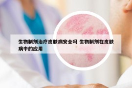 生物制剂治疗皮肤病安全吗 生物制剂在皮肤病中的应用