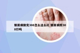 银屑病做完308怎么这么红 银屑病照308行吗