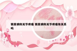 银屑病和关节疼痛 银屑病和关节疼痛有关系吗