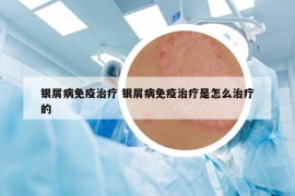 银屑病免疫治疗 银屑病免疫治疗是怎么治疗的