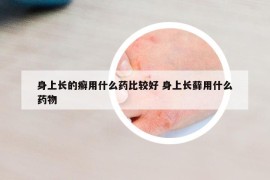 身上长的癣用什么药比较好 身上长藓用什么药物