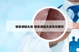 银屑病输头孢 银屑病输头孢有效果吗