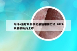 阿维a治疗银屑病的最佳服用方法 2024银屑病新药上市