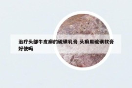 治疗头部牛皮癣的硫磺乳膏 头癣用硫磺软膏好使吗