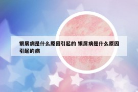 银屑病是什么原因引起的 银屑病是什么原因引起的病