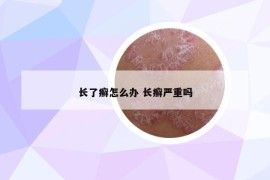 长了癣怎么办 长癣严重吗