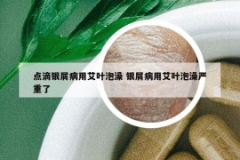 点滴银屑病用艾叶泡澡 银屑病用艾叶泡澡严重了