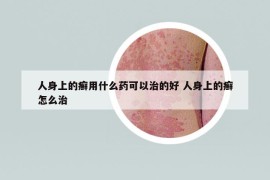 人身上的癣用什么药可以治的好 人身上的癣怎么治