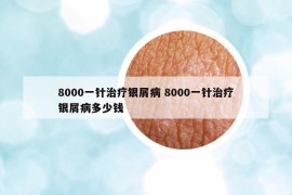 8000一针治疗银屑病 8000一针治疗银屑病多少钱