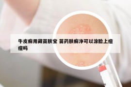 牛皮癣用藏苗肤宝 苗药肤癣净可以涂脸上痘痘吗