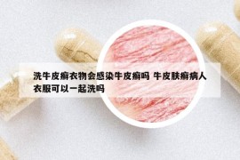 洗牛皮癣衣物会感染牛皮癣吗 牛皮肤癣病人衣服可以一起洗吗