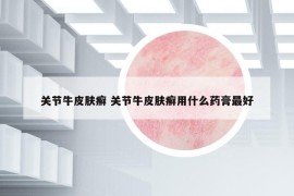 关节牛皮肤癣 关节牛皮肤癣用什么药膏最好