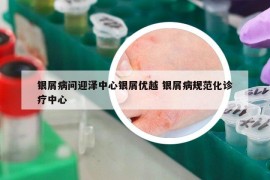 银屑病问迎泽中心银屑优越 银屑病规范化诊疗中心