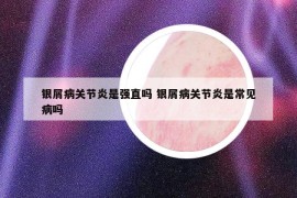 银屑病关节炎是强直吗 银屑病关节炎是常见病吗