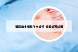 银屑病多喝栀子水好吗 银屑病可以喝