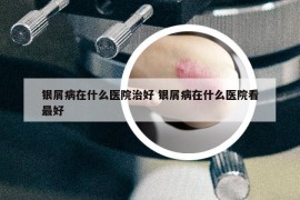 银屑病在什么医院治好 银屑病在什么医院看最好