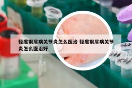 轻度银屑病关节炎怎么医治 轻度银屑病关节炎怎么医治好