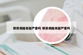 银屑病越老越严重吗 银屑病越来越严重吗