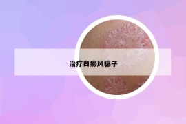 治疗白癜风骗子